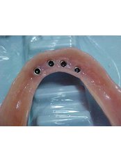 Mini Implants - B&C Dental Care Dr.Carlos Suárez