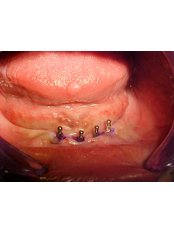 Mini Implants - B&C Dental Care Dr.Carlos Suárez
