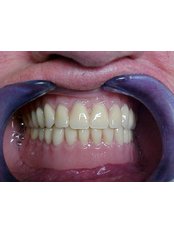 Dentures - B&C Dental Care Dr.Carlos Suárez