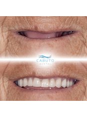 Smile Makeover - Cabuto Dental