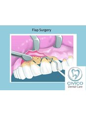 Gingival Flap Surgery (start at) per quadrant - CIVICO DENTAL CARE