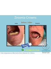 Zirconia Crown - CIVICO DENTAL CARE