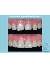 Composite Injectable technique (per tooth) - CIVICO DENTAL CARE
