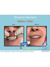 Zirconia Veneers - CIVICO DENTAL CARE