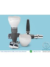 Titanium Dental Implant (including abutment and crown) - CIVICO DENTAL CARE