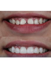 Veneers - Dentaire-dentistry Expert