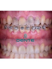 Orthodontics - Dente