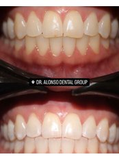 Teeth Whitening - Dr Alonso Dental Group