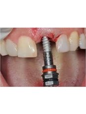Dental Implants - Dr Jesus Osorio Rios Mexicali Dentist