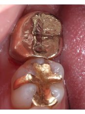 Gold Crown - Dr. Kim Dentistry by IPSE
