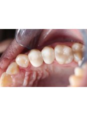 Zirconia Crown - Dr. Kim Dentistry by IPSE