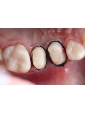 Zirconia Crown - Dr. Kim Dentistry by IPSE