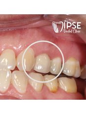 Restoration of Implants - Dr. Kim Dentistry by IPSE