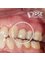 Dr. Kim Dentistry by IPSE - zirconia crown on implant 