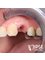 Dr. Kim Dentistry by IPSE - 4 month later gum managment 