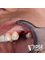 Dr. Kim Dentistry by IPSE - #12 extraction and immediate dental implant placement 
