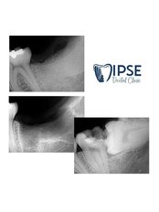 Bone Graft - Dr. Kim Dentistry by IPSE