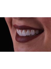 DSD - Digital Smile Design - Dr. Kim Dentistry by IPSE
