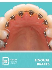 Lingual Braces - Estrada Dental Group