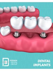 Dental Implants - Estrada Dental Group