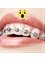 Estrada Dental Group - Metalic self ligating brackets. 