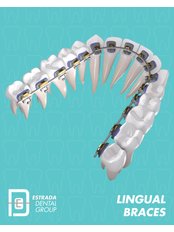Lingual Braces - Estrada Dental Group
