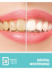 Teeth Whitening - Estrada Dental Group