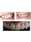 Orthodontics and Dental Aesthetics - Full ceramic crowns 