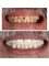 Orthodontics and Dental Aesthetics - full ceramic crowns 