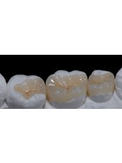 Porcelain Inlay or Onlay - Simply Dental - Mexicali