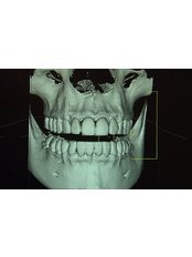 3D Dental X-Ray - Simply Dental - Mexicali