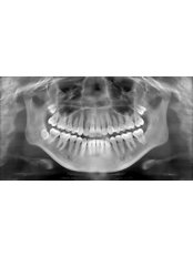 Digital Panoramic Dental X-Ray - Simply Dental - Mexicali