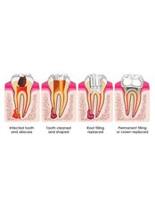 Root Canals - Simply Dental - Mexicali