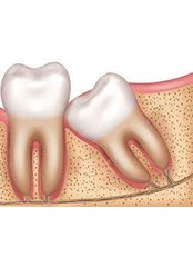 Wisdom Tooth Extraction - Simply Dental - Mexicali