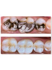 Fillings - Simply Dental - Mexicali