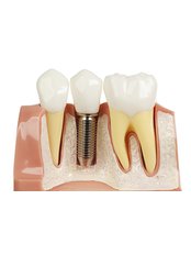 Dental Implants (Implant only) - H&H Dental Implants