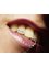 Re New Dental - Dental Diamonds: Temporary, Painless and Safe 