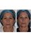 Smile Implant Center - Before and after facial harmonization 