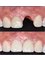 Smile Implant Center - Dental Implant results 