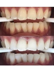 Teeth Whitening - Smile Designers