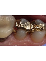 Gold Inlay or Onlay - Dental Laser Nogales
