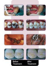 Pulpotomy - Dental Laser Nogales