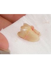 Wisdom Tooth Extraction - Dental Laser Nogales