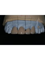 Dental Bridges - Dental Laser Nogales