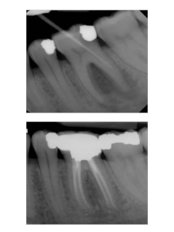 Root canals - Dental Laser Nogales