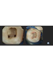Pulpotomy - Dental Laser Nogales