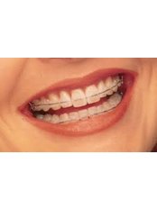 Clear Braces - Dental Laser Nogales