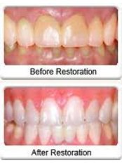 Laser Teeth Whitening - Dental Laser Nogales