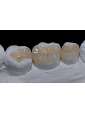 Inlay or Onlay - Dental Line