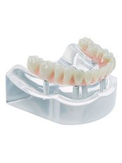 6 implant high water fixed bridge - Dentalperiogroup